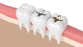 Different Types of Dental Fillings and Which One Is Right for You