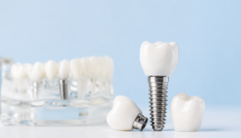 Dental Implants Mississauga: A Complete Guide to Replacing Missing Teeth